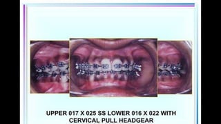 HIGH PULL HEADGEAR.pptx