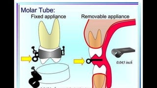HIGH PULL HEADGEAR.pptx