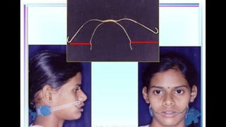 HIGH PULL HEADGEAR.pptx