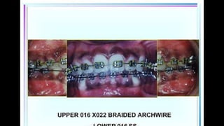 HIGH PULL HEADGEAR.pptx