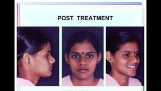 HIGH PULL HEADGEAR.pptx