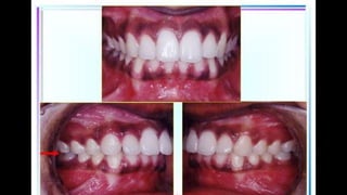 HIGH PULL HEADGEAR.pptx