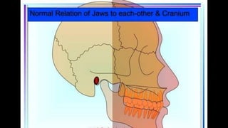 HIGH PULL HEADGEAR.pptx