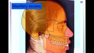 HIGH PULL HEADGEAR.pptx