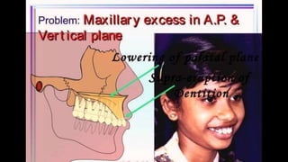 HIGH PULL HEADGEAR.pptx