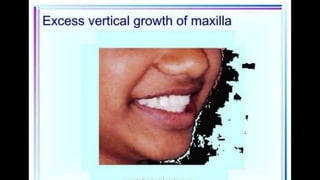 HIGH PULL HEADGEAR.pptx