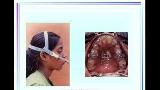 HIGH PULL HEADGEAR.pptx