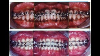 HIGH PULL HEADGEAR.pptx