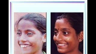 HIGH PULL HEADGEAR.pptx