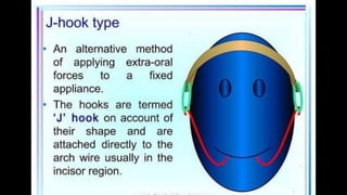 HIGH PULL HEADGEAR.pptx