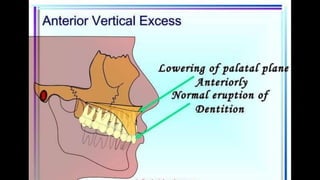 HIGH PULL HEADGEAR.pptx