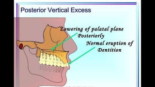 HIGH PULL HEADGEAR.pptx