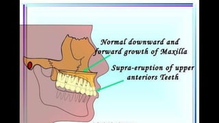HIGH PULL HEADGEAR.pptx