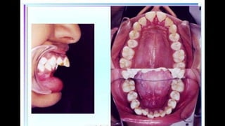 HIGH PULL HEADGEAR.pptx