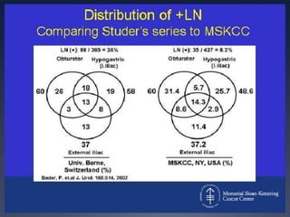 External iliac dissection (above obturator nerve) detects only 36% of patients with +LN.