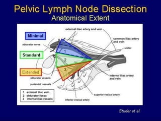 Linfadenectomia AdequadaMSKCC – 3721 PRN1: 5,2%Risco baixo: 0,5%Risco intermediário: 5%Risco alto: 21%É atualmente recomendada para todos com risco intermediário ou alto (nomograma ≥ 2%)Quando realizada: alargadaIncidenceof +LN withfull PLND in contemporary RP series. MSKCC, 2010