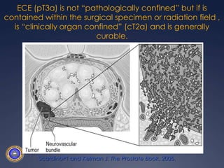 ECE (pT3a) is not “pathologically confined” but if is contained within the surgical specimen or radiation field , is “clinically organ confined” (cT2a) and is generally curable.ScardinoPT and Kelman J: The Prostate Book, 2005. 