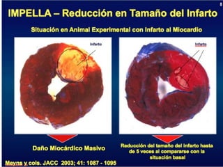 UPDATE OF HIGH RISK PCI . . . IMPELLA vs IABP : INCLUDES  THE SHOCK II TRIAL