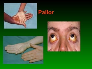 Pallor
 