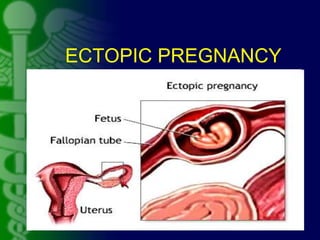 ECTOPIC PREGNANCY
 