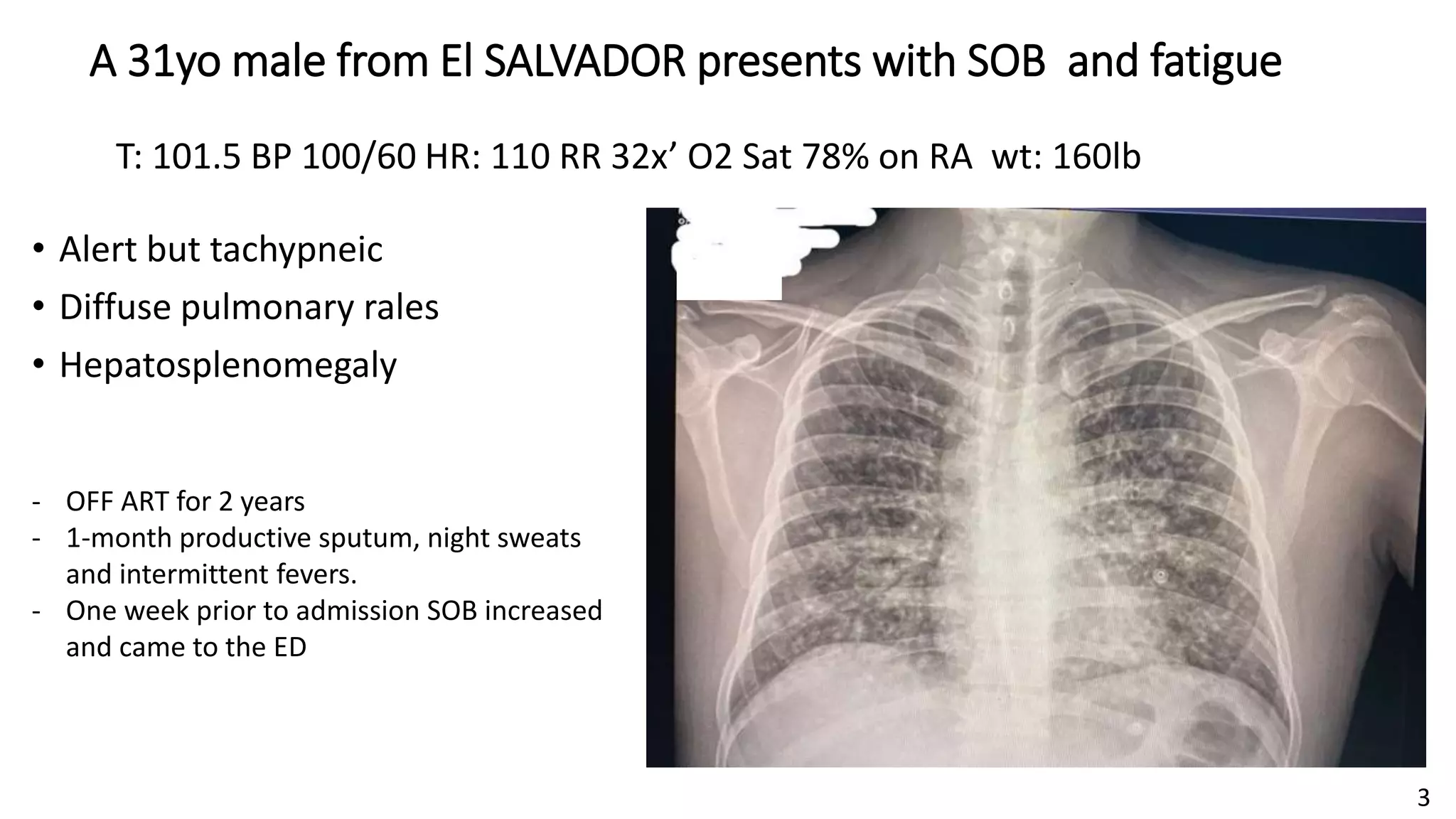 • Alert but tachypneic
• Diffuse pulmonary rales
• Hepatosplenomegaly
3
T: 101.5 BP 100/60 HR: 110 RR 32x’ O2 Sat 78% on RA wt: 160lb
A 31yo male from El SALVADOR presents with SOB and fatigue
- OFF ART for 2 years
- 1-month productive sputum, night sweats
and intermittent fevers.
- One week prior to admission SOB increased
and came to the ED
 