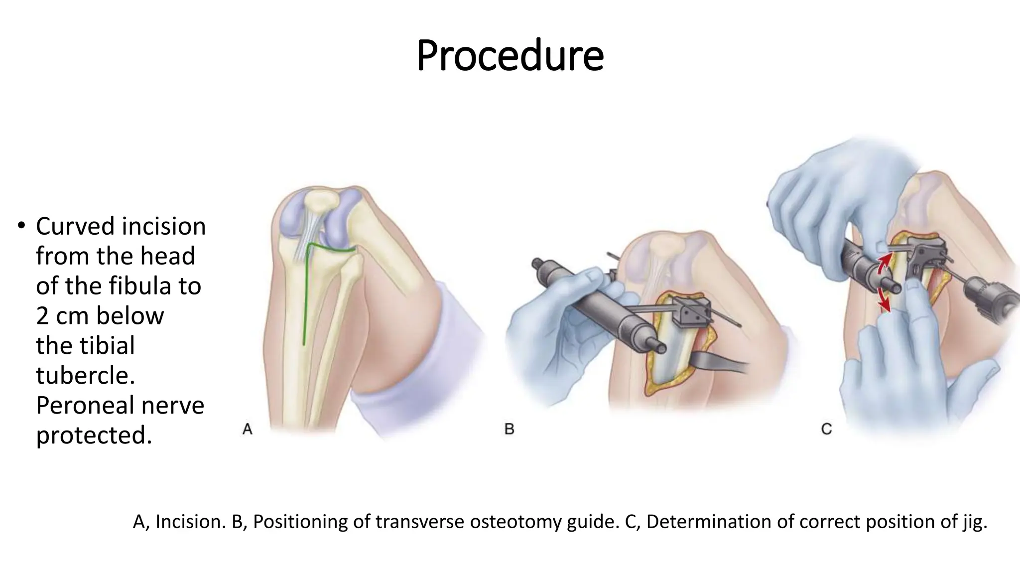 HIGH TIBIAL OSTEOTOMY AROUND THE KNEE pptx