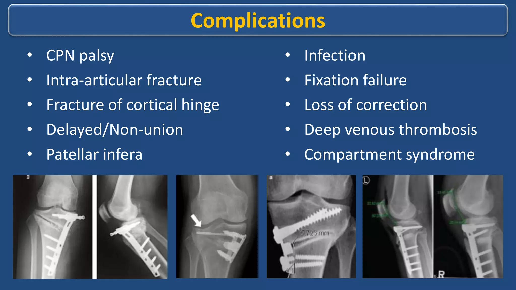 High tibial osteotomy | PPTX