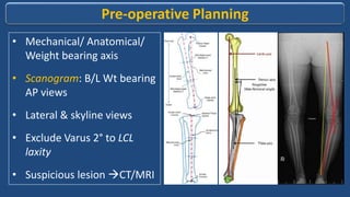 High tibial osteotomy | PPTX