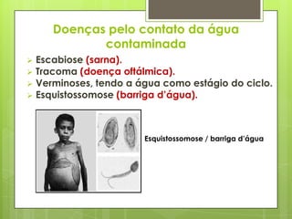 Doenças pelo contato da água
contaminada
 Escabiose (sarna).
 Tracoma (doença oftálmica).
 Verminoses, tendo a água como estágio do ciclo.
 Esquistossomose (barriga d’água).
Esquistossomose / barriga d’água
 