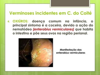 Verminoses incidentes em C. do Coité
4. OXIÚROS: doença comum na infância, o
principal sintoma é a coceira, devido a ação do
nematódeo (enterobius vermiculares) que habita
o intestino e põe seus ovos na região perianal.
Manifestação das
enterobius vermiculares
 
