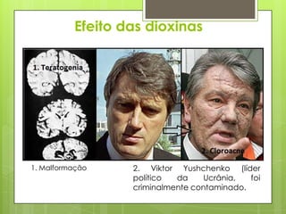 Efeito das dioxinas
2. Viktor Yushchenko (líder
político da Ucrânia, foi
criminalmente contaminado.
1. Malformação
 
