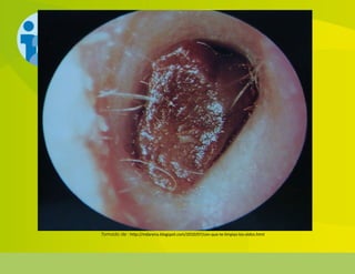 Tomado de : http://mdarena.blogspot.com/2010/07/con-que-te-limpias-los-oidos.html
 