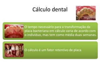 Cálculo dental
O tempo necessário para a transformação da
placa bacteriana em cálculo varia de acordo com
o indivíduo, mas tem como média duas semanas.
O cálculo é um fator retentivo de placa
 