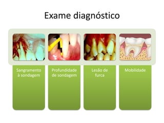 Exame diagnóstico
Sangramento
à sondagem
Profundidade
de sondagem
Lesão de
furca
Mobilidade
 