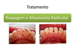 Tratamento
Raspagem e Alisamento Radicular
 