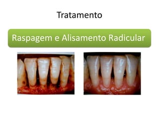 Tratamento
Raspagem e Alisamento Radicular
 