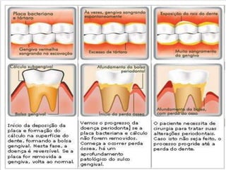 Processo Saúde-doença  e Higiene Dental