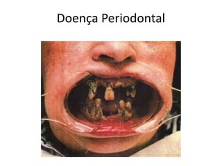 Doença Periodontal
 