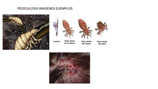 PEDICULOSIS IMAGENES EJEMPLOS
 