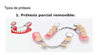 Tipos de prótesis
 