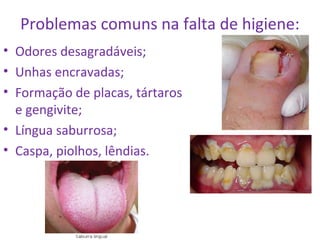 Problemas comuns na falta de higiene: 
• Odores desagradáveis; 
• Unhas encravadas; 
• Formação de placas, tártaros 
e gengivite; 
• Língua saburrosa; 
• Caspa, piolhos, lêndias. 
 