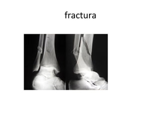 fractura 