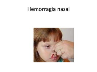 Hemorragia nasal 