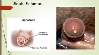 Sinais, Sintomas. 
 