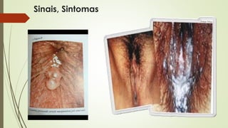 Sinais, Sintomas 
 