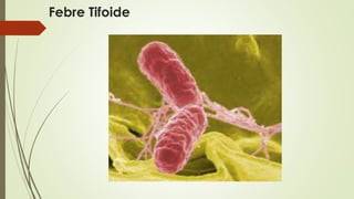 Febre Tifoide 
 