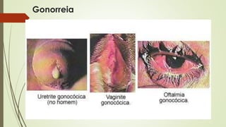Gonorreia 
 