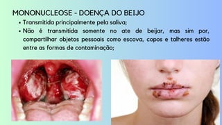 Transmitida principalmente pela saliva;
Não é transmitida somente no ate de beijar, mas sim por,
compartilhar objetos pessoais como escova, copos e talheres estão
entre as formas de contaminação;
MONONUCLEOSE - DOENÇA DO BEIJO
 
