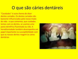 O que são cáries dentáreis  ? “ Cavidades” é outra forma de dizer dentes cariados. Os dentes cariados são bastante influenciados pelo nosso modo de vida - o que comemos, que cuidados temos com os dentes, se usamos uma pasta dentífrica fluoretada ou não. A hereditariedade também desempenha um papel importante na susceptibilidade com que os nossos dentes reagem às cáries dentárias . 