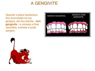 A GENGIVITE
GENGIVA SAUDÁVEL
GENGIVA COM
GENGIVITE
Quando a placa bacteriana
fica acumulada na tua
gengiva, ela fica doente - tem
gengivite - e começa a ficar
vermelha, inchada e pode
sangrar.
 